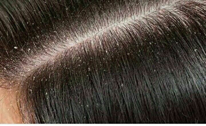 Solusi Tuntas Membasmi Kutu Rambut: Cara Alami dan Medis yang Paling Ampuh