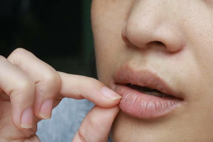 Bibir Kering dan Pecah-Pecah? Kenali Penyebab dan Cara Mengatasinya