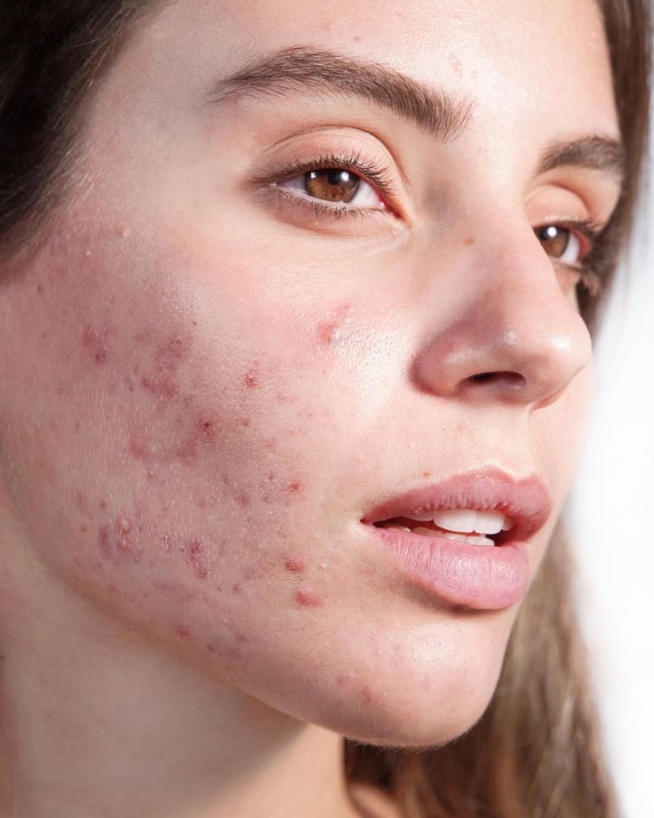 Bingung Wajah Break Out atau Purging? Ini Dia Perbedaannya!