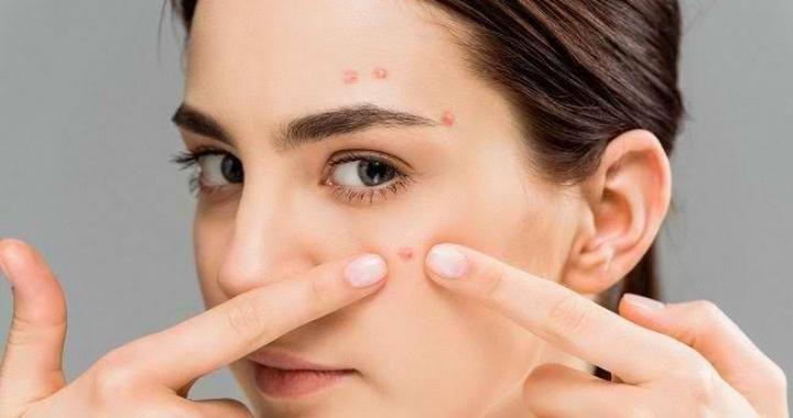 Cara Merawat Wajah Agar Terhindar dari Jerawat