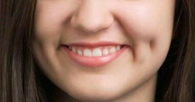 Pesona Lesung Pipi: Keindahan Estetika yang Berawal dari Kelainan Otot Wajah