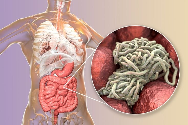 Waspada, Ini Tanda Tubuhmu Mengalami Infeksi Cacing Parasit