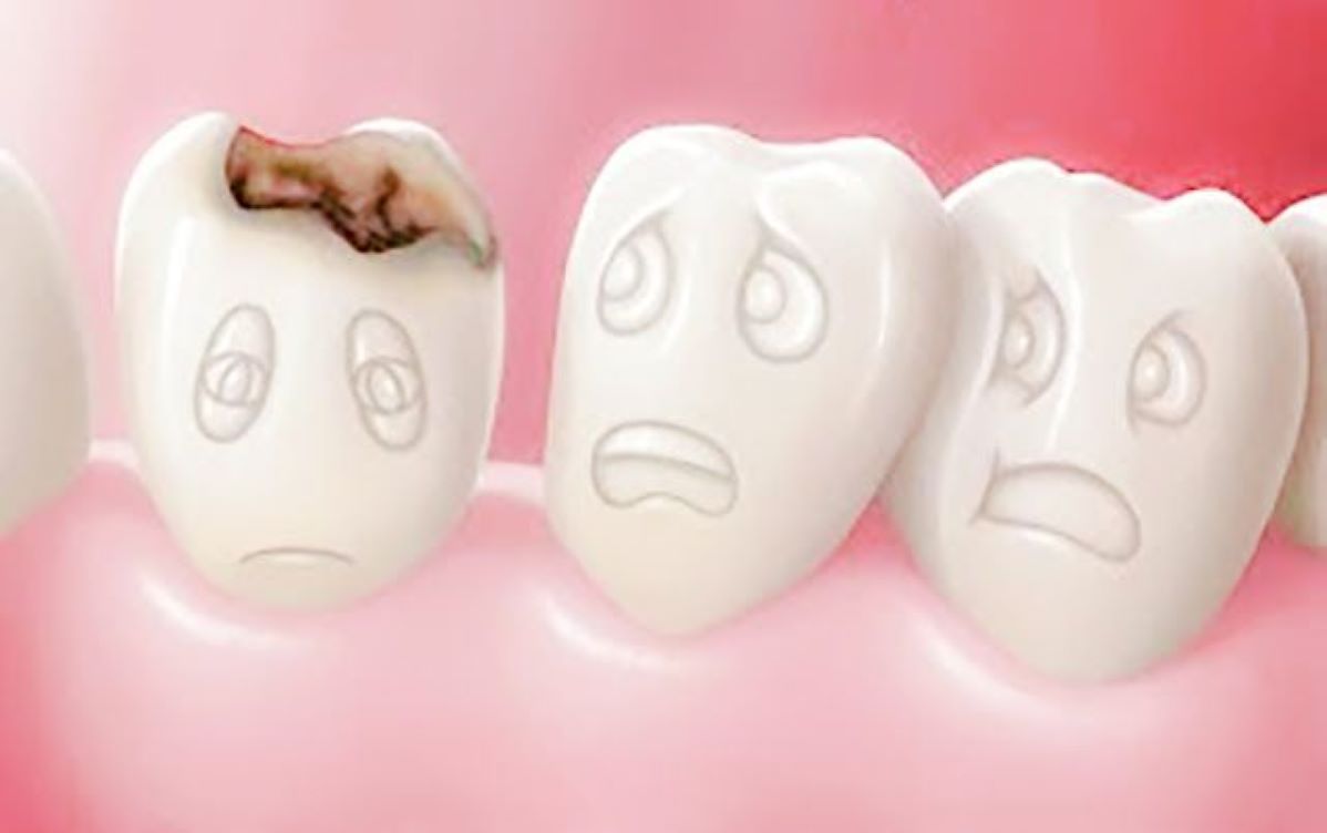 Waspada! Gigi Berlubang Ternyata Berisiko Penyakit Jantung