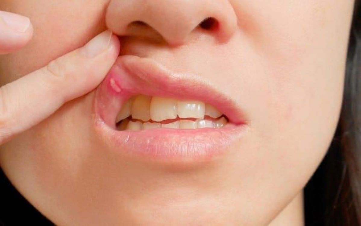 Perhatikan Ciri Ini! Sariawan Tak Kunjung Sembuh Bisa Jadi Tanda Kanker Mulut