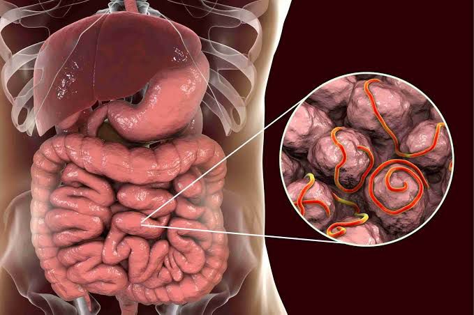 Waspada Cacingan, Jangan Sepelekan Dampaknya