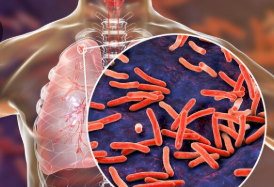 Lampung Hadapi Tantangan 31 Ribu Kasus TBC, Pemerintah Siapkan RAD 2025-2030