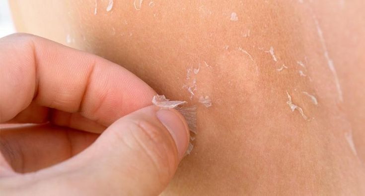 Tujuh Tips Mengatasi Kulit Kering Saat Musim Hujan: Tetap Lembap dan Sehat