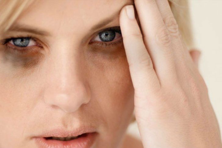 Kembalikan Kesegaran Wajah: Tips Ampuh Menghilangkan Mata Panda secara Alami dan Efektif