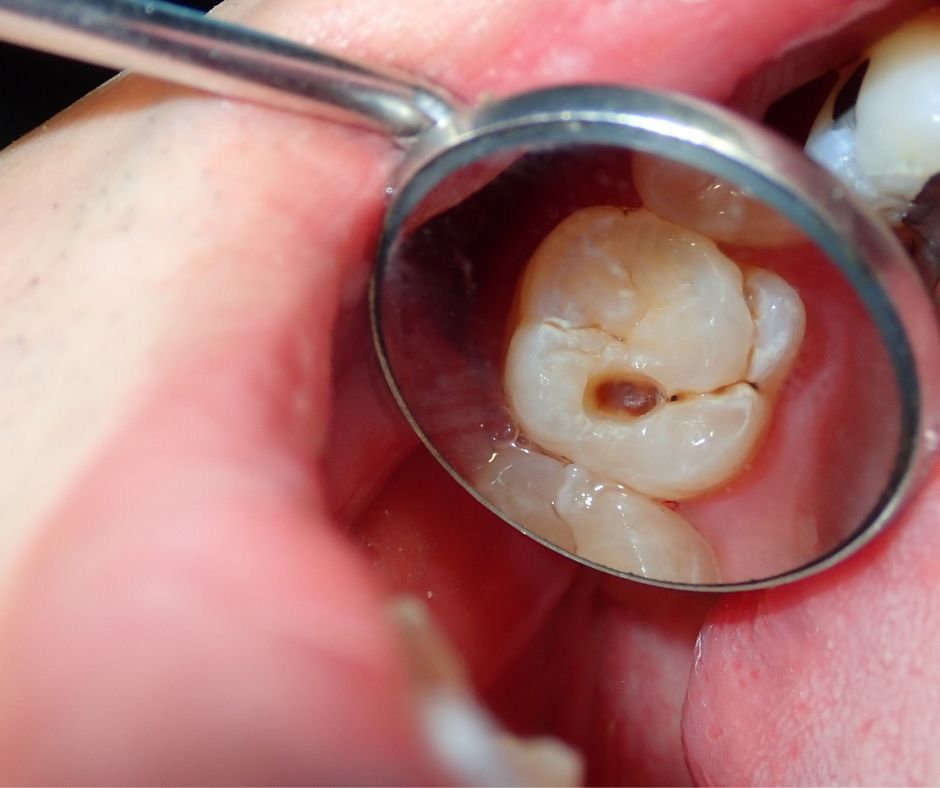 Kamu Harus Tahu! Berikut Ini 5 Langkah Mudah Menjaga Gigi Agar Tetap Sehat dan Bebas Lubang