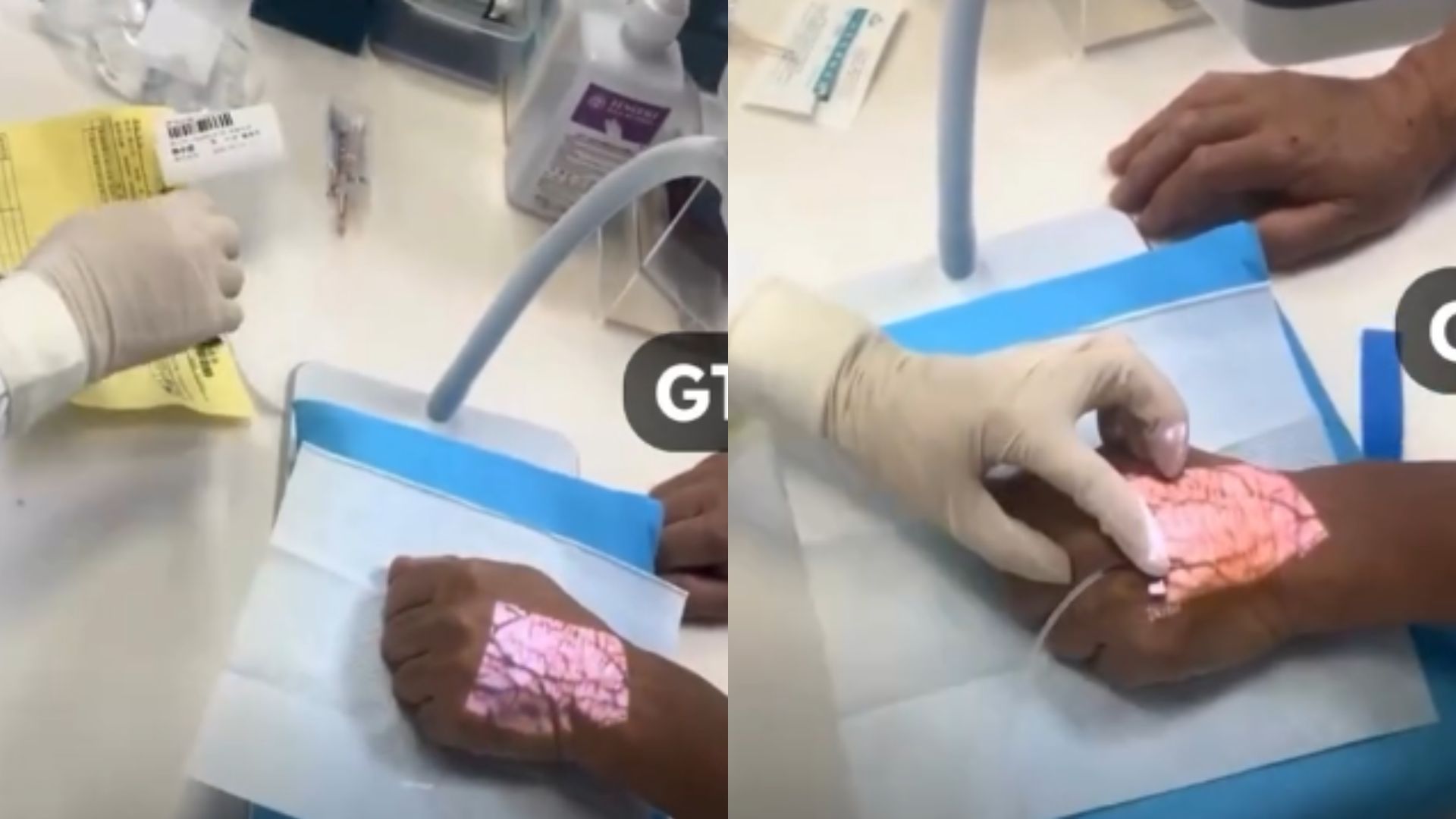 Rumah Sakit di China Gunakan Teknologi “Cahaya Tembus Kulit” untuk Deteksi Pembuluh Darah