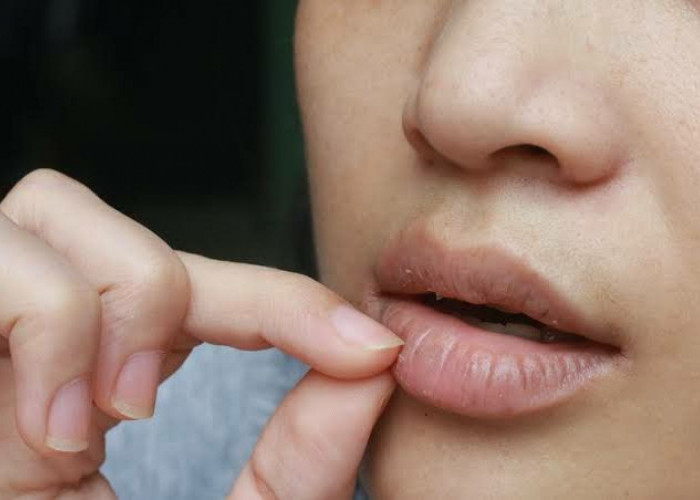 Bibir Kering dan Pecah-Pecah? Kenali Penyebab dan Cara Mengatasinya