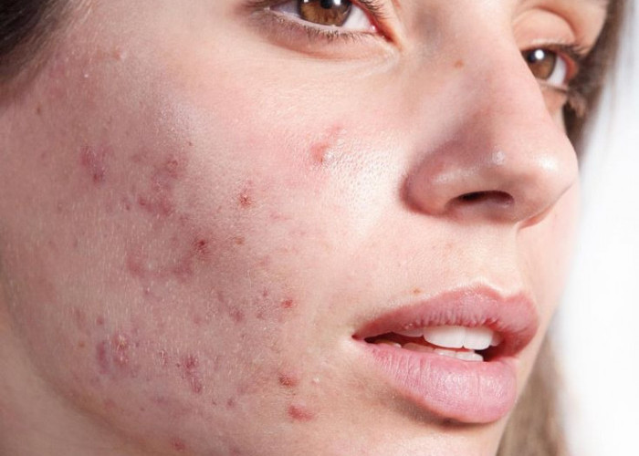Bingung Wajah Break Out atau Purging? Ini Dia Perbedaannya!