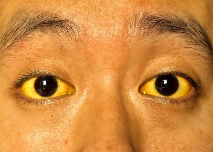Memahami Penyakit Kuning: Mengapa Kulit dan Mata Berubah Warna?