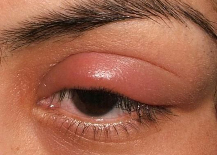 Benarkah Mata Bintitan Terjadi karena Suka Mengintip? Ini Fakta Medis yang Perlu Diketahui