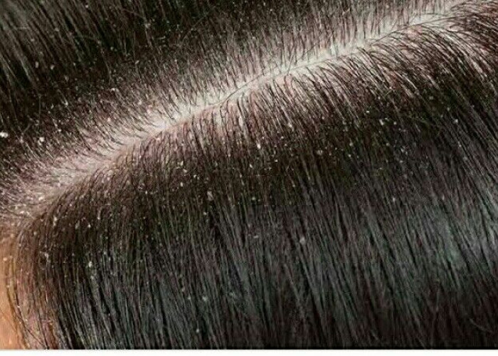 Sudah Sering Keramas Tapi Tetap Ketombean? Ternyata Ini Penyebabnya