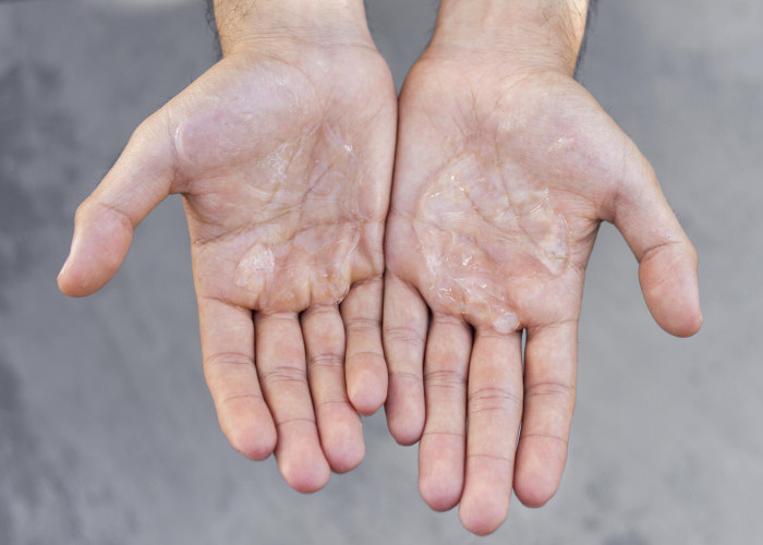 Kenali Penyebab Tangan Berkeringat Berlebihan dan Cara Mengatasinya dengan Mudah