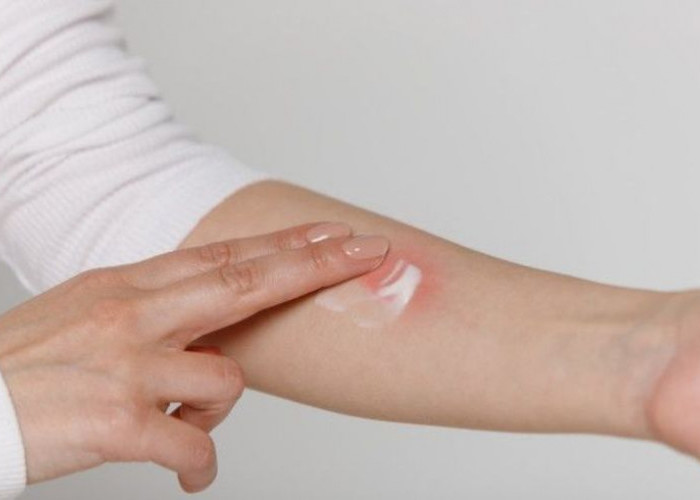 Kembalikan Percaya Diri: Cara Ampuh Menghilangkan Bekas Luka Secara Alami dan Medis