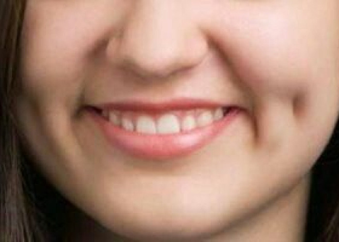 Pesona Lesung Pipi: Keindahan Estetika yang Berawal dari Kelainan Otot Wajah