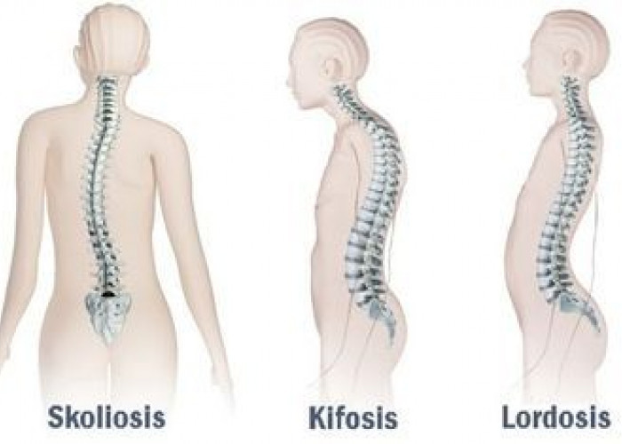 Bisa Bikin Tulang Miring! Ini Bahaya Duduk di Atas Dompet Saku Belakang yang Wajib Sobat Radar Waspadai
