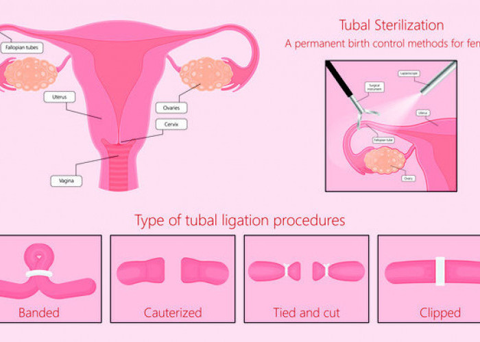 Tubektomi: Prosedur Kontrasepsi Permanen untuk Wanita