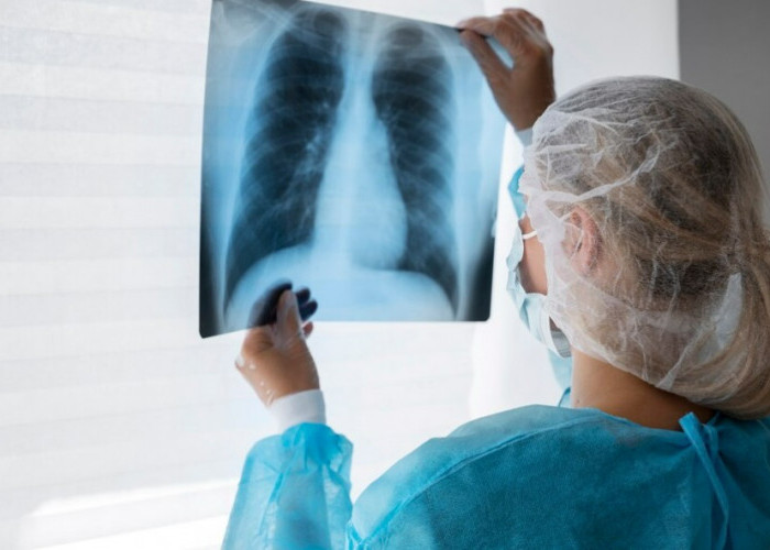 PR Berat Atasi TBC : Indonesia Peringkat 2 Dunia Kasus Tuberkulosis 