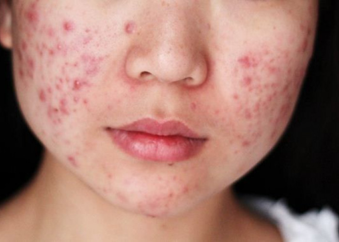 Bukan Sekadar Debu: Bedah Tuntas Alasan Mengapa Wajahmu Terus 'Panen' Jerawat