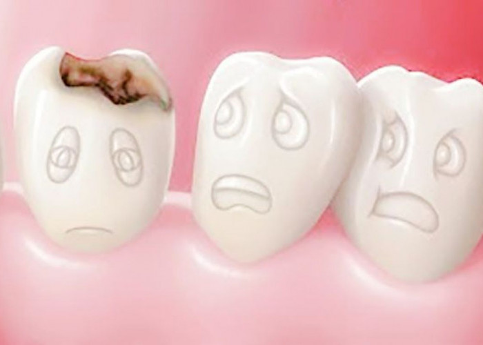 Waspada! Gigi Berlubang Ternyata Berisiko Penyakit Jantung