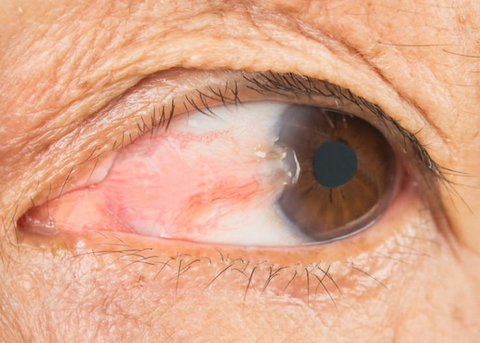 Waspada Pterygium, Ini Alasan Penting Pakai Kacamata Hitam saat Beraktivitas di Luar Rumah