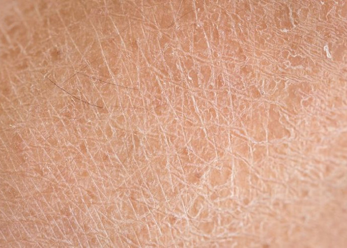 Penyebab Kulit Menjadi Kering, Ini Faktor Internal dan External Pemicunya!