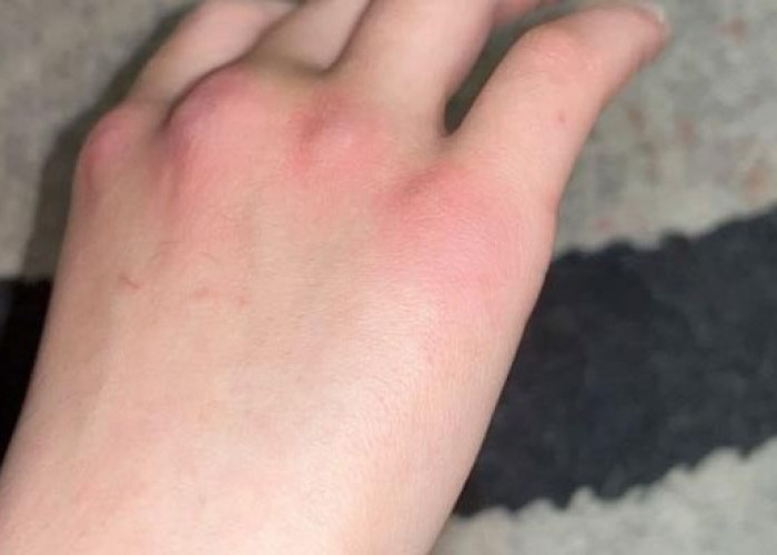 Mengenal Istilah “Darah Manis” dan Cara Mencegah Gatal Berulang pada Kulit