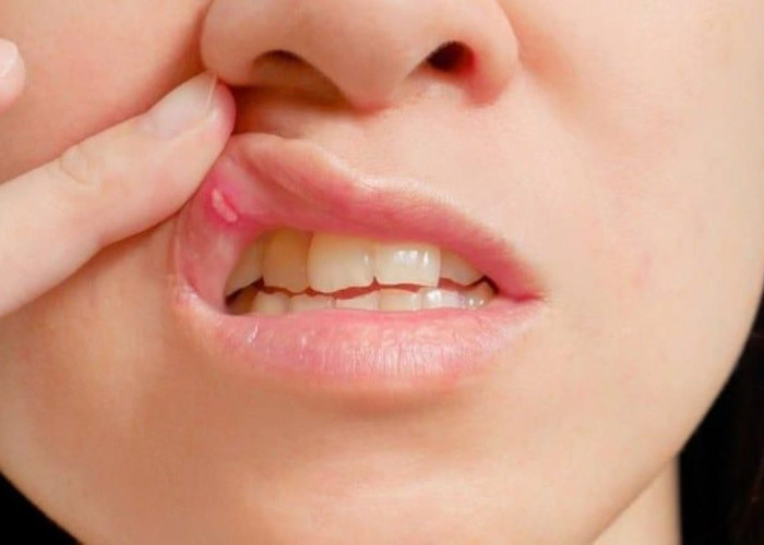 Perhatikan Ciri Ini! Sariawan Tak Kunjung Sembuh Bisa Jadi Tanda Kanker Mulut