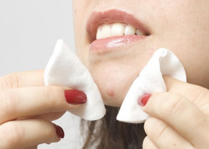 Bahaya Memencet Jerawat Yang Sering Diabaikan, Bisa Merusak Kulit Wajah