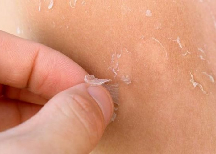 Tujuh Tips Mengatasi Kulit Kering Saat Musim Hujan: Tetap Lembap dan Sehat