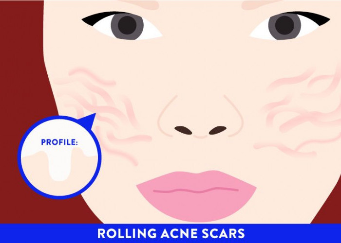 Masalah Teratasi! Ini dia Cara Mengatasi Bekas Jerawat