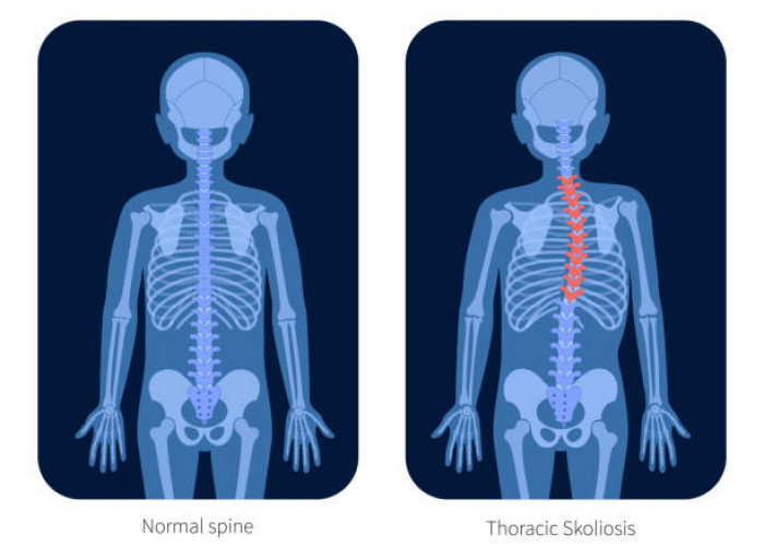 Skoliosis: Gangguan Tulang Belakang yang Sering Tak Disadari