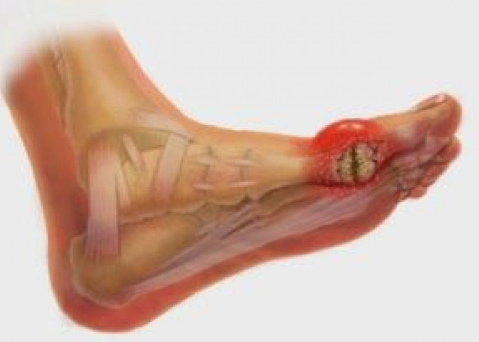 Waspada! Daftar Makanan Pemicu Asam Urat yang Harus Dibatasi Demi Sendi Sehat