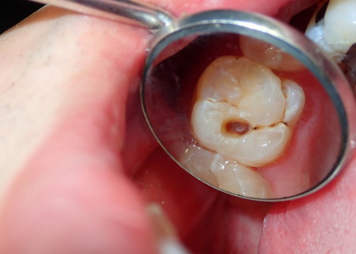 Kamu Harus Tahu! Berikut Ini 5 Langkah Mudah Menjaga Gigi Agar Tetap Sehat dan Bebas Lubang