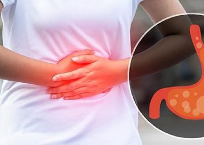 Penderita Asam Lambung Perlu Lebih Selektif, Konsumsi Buah Tertentu Dapat Memicu Gejala Kambuh