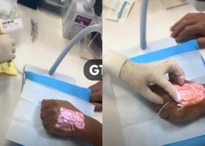 Rumah Sakit di China Gunakan Teknologi “Cahaya Tembus Kulit” untuk Deteksi Pembuluh Darah