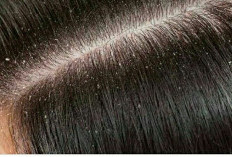 Solusi Tuntas Membasmi Kutu Rambut: Cara Alami dan Medis yang Paling Ampuh