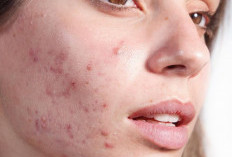 Bingung Wajah Break Out atau Purging? Ini Dia Perbedaannya!