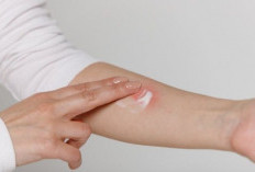 Kembalikan Percaya Diri: Cara Ampuh Menghilangkan Bekas Luka Secara Alami dan Medis