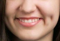 Pesona Lesung Pipi: Keindahan Estetika yang Berawal dari Kelainan Otot Wajah