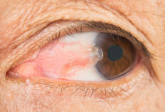 Waspada Pterygium, Ini Alasan Penting Pakai Kacamata Hitam saat Beraktivitas di Luar Rumah
