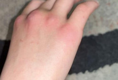 Mengenal Istilah “Darah Manis” dan Cara Mencegah Gatal Berulang pada Kulit