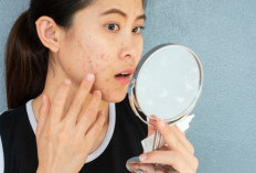 Kulit Berjerawat Masih Jadi Masalah Umum, Begini Cara Mengatasinya Dengan Tepat