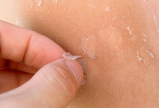 Tujuh Tips Mengatasi Kulit Kering Saat Musim Hujan: Tetap Lembap dan Sehat