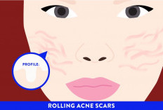 Masalah Teratasi! Ini dia Cara Mengatasi Bekas Jerawat