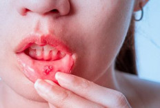 Sariawan Tak Kunjung Hilang? Ini Kebiasaan yang Perlu Mulai Diperhatikan