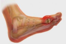 Waspada! Daftar Makanan Pemicu Asam Urat yang Harus Dibatasi Demi Sendi Sehat